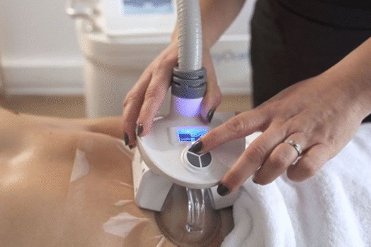 Comment se préparer à une séance de cryolipolyse ?