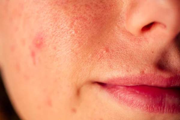 Les actifs SOS à privilégier pour les rougeurs : centella asiatica, niacinamide, panthénol, aloe vera.
