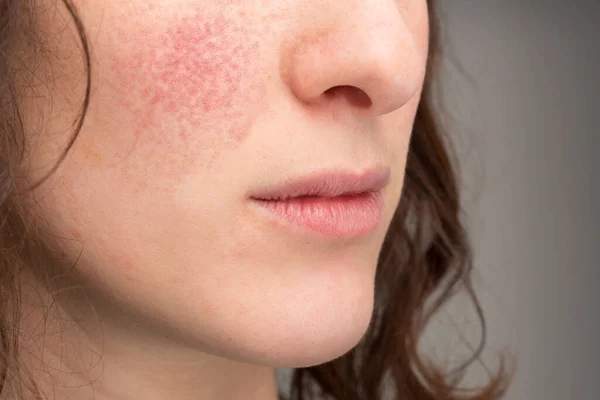 Comment identifier la cause de ses rougeurs (rosacée, sensibilité, irritation…)