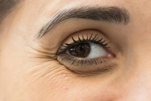 Cernes ethniques : pourquoi sont-ils plus difficiles à traiter ?